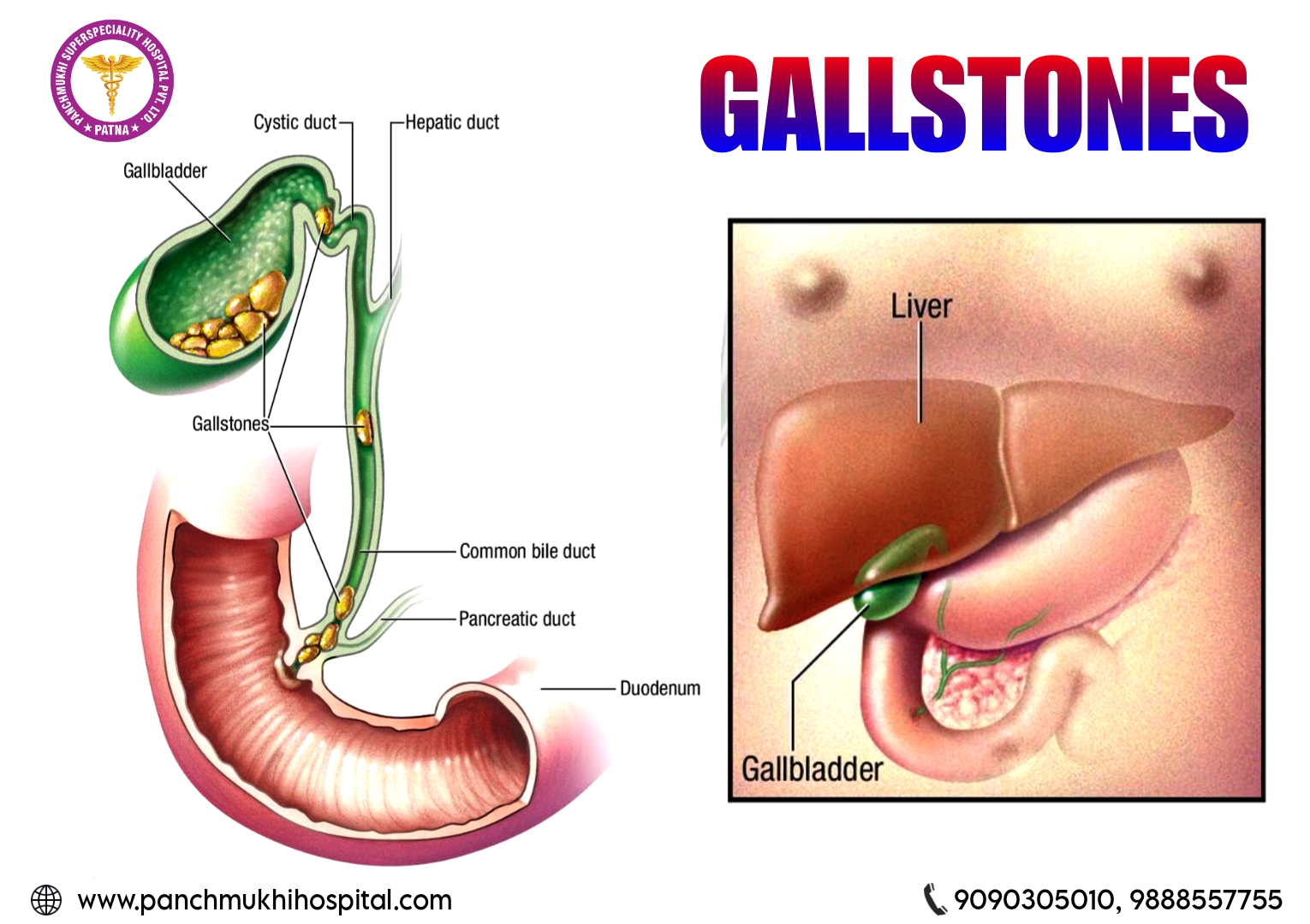 Gallstones can be Life Threatening if Not Treated on Time