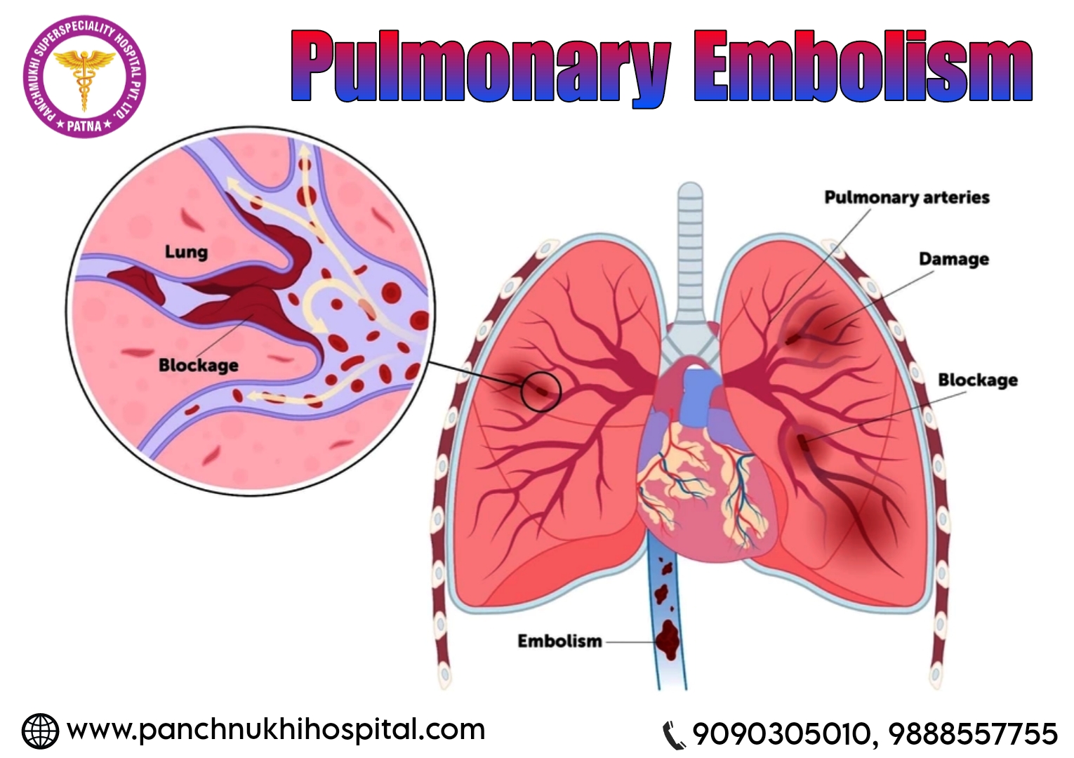 Panchmukhi Superspeciality Hospital Pvt Ltd, Patna Offers the Best Treatment for Pulmonary Diseases